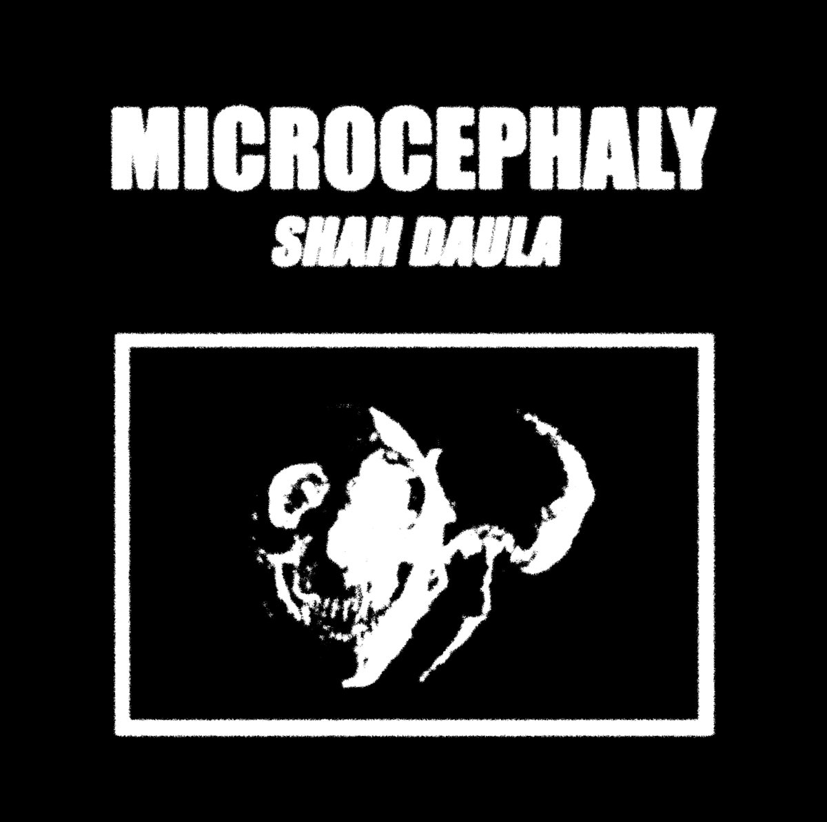 Microcephaly